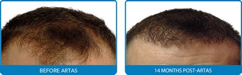 hair transplant albuquerque